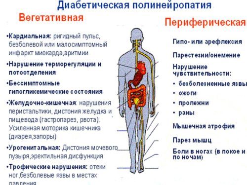 Аксональная полинейропатия