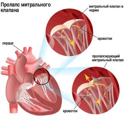 Пролапс митрального клапана 2 степени