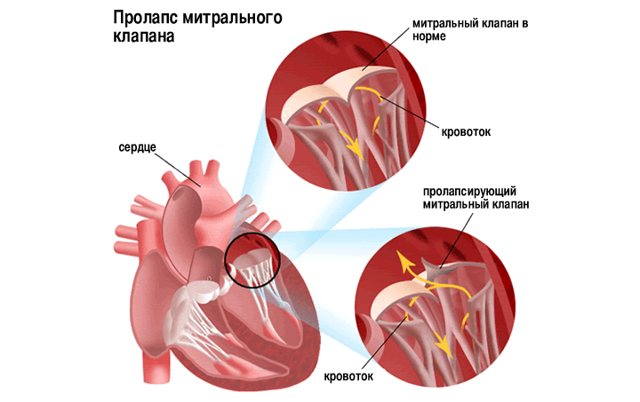 Пролапс митрального клапана – что это, чем опасен?