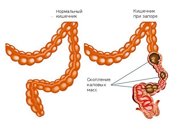 Слабительные свечи при запорах у взрослых быстрого действия