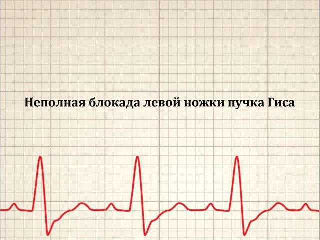 Неполная блокада левой ножки пучка Гиса - причины, лечение