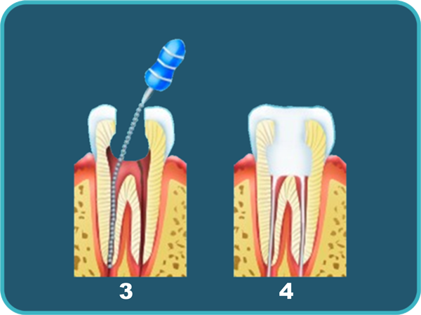 Пришеечный кариес - причины, симптомы, диагностика и лечение