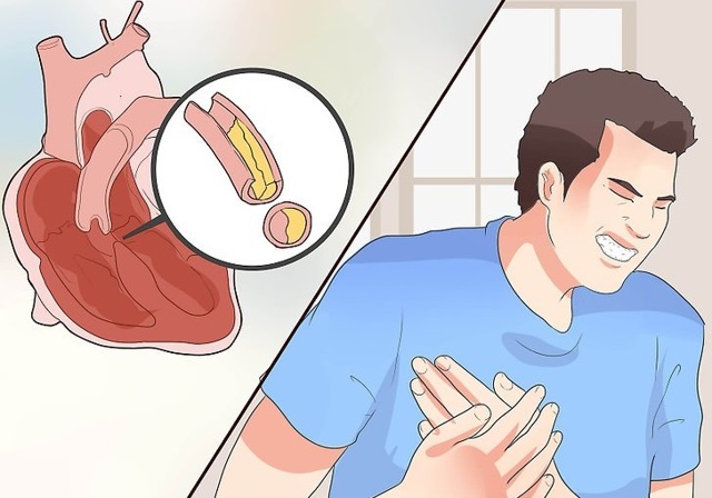 Стенокардия напряжения: функциональные классы