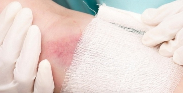 Флебит вены на руке. Лечение постинъекционного флебита после катетера