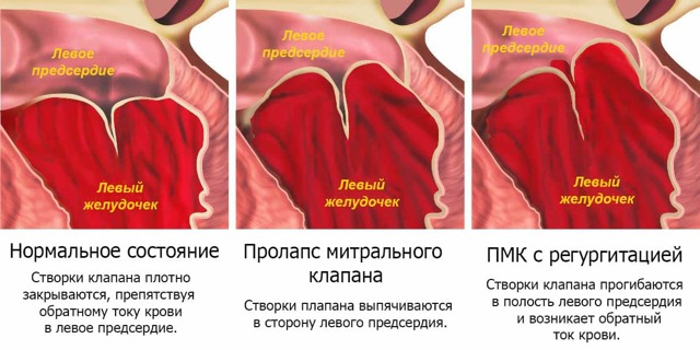 Порок митрального клапана сердца