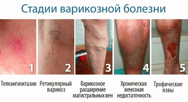 Кдо что это такое | Все о ретикулярном варикозе
