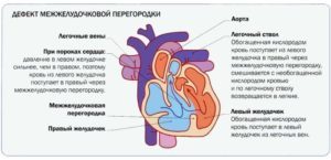 Неполная межжелудочковая перегородка имеется в сердце - Универ soloBY