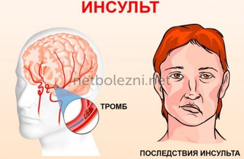 Предпосылки инсульта головного мозга у женщин - как избежать инсульта у женщин
