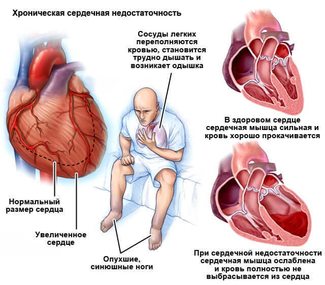 Милдронат - применение, инструкция, показания