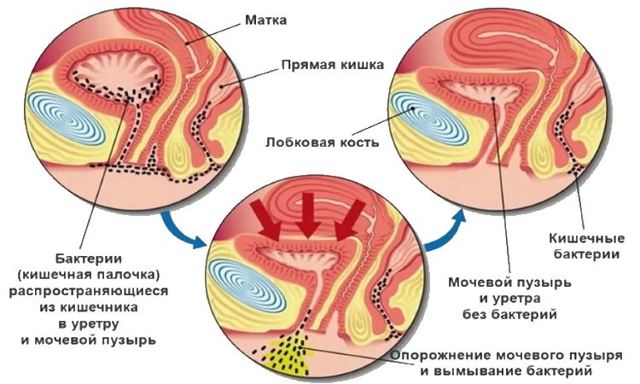 Острый цистит у женщин: симптомы и лечение