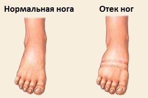 Дисметаболическая кардиомиопатия: симптомы и лечение