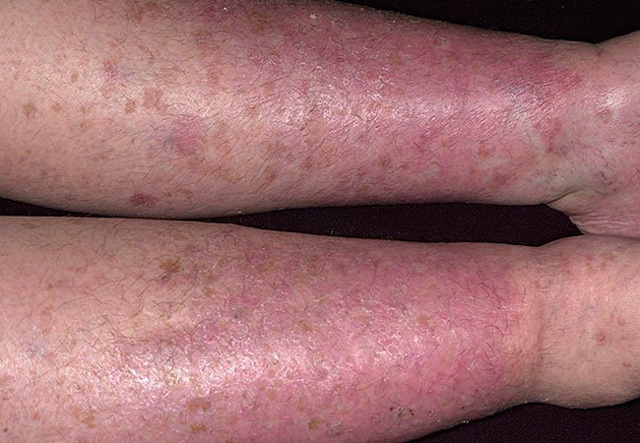 Варикозный дерматит нижних конечностей лечение народными средствами на сайте варикоз
