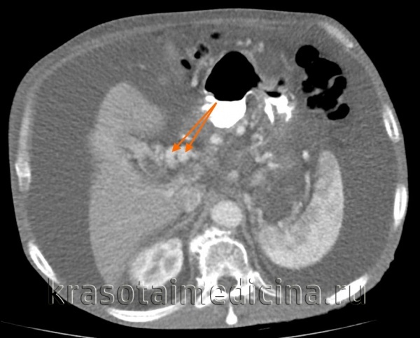 Билиарная гипертензия печени: симптомы, признаки на УЗИ и лечение синдрома
