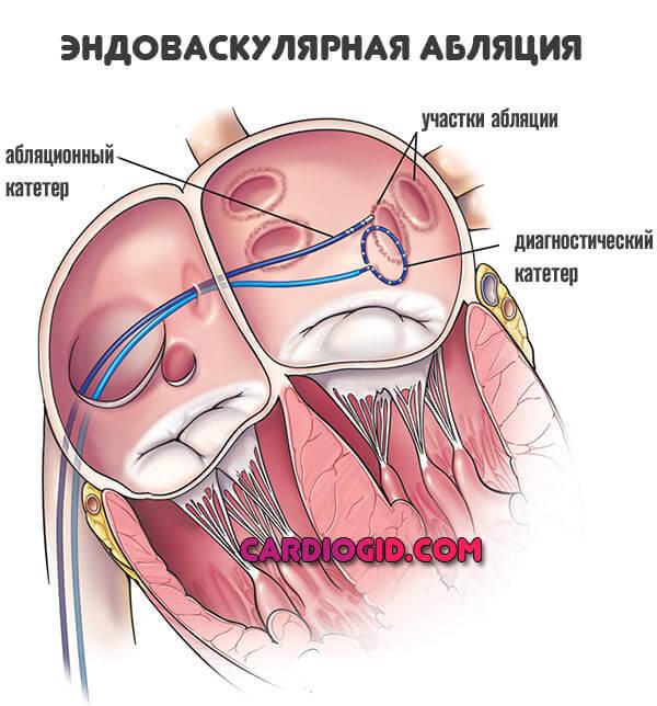 Отеки ног при сердечной недостаточности