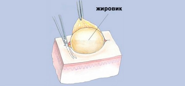 Жировики на лице: причины возникновения, как избавиться. Удаление жировиков, липом на лице белых, мелких, подкожных
