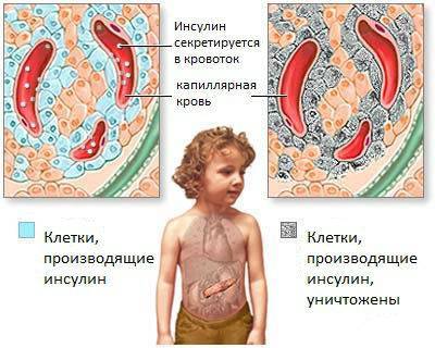 Первые признаки и симптомы сахарного диабета