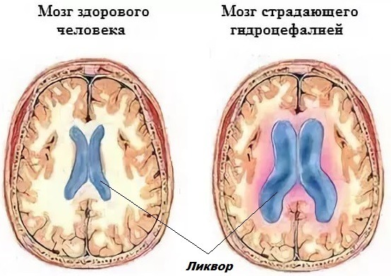 Гипертензионный синдром у детей и взрослых: симптомы, лечение