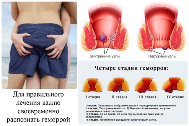 Как обезболить геморрой в домашних условиях быстро