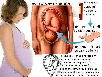 Первые признаки и симптомы сахарного диабета