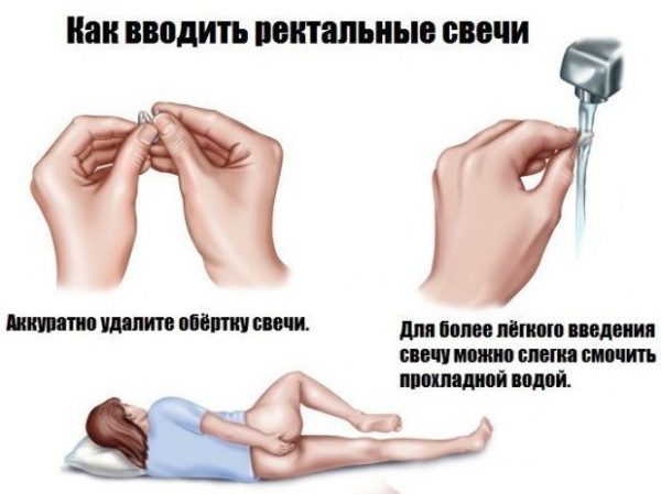 Слабительные свечи при запорах у взрослых быстрого действия