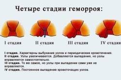 Если свечи релиф не помогают. Как быстро помогает релиф свечи