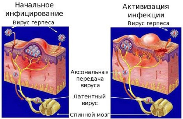 Опоясывающий лишай (герпес зостер): симптомы и лечение у взрослых, фото