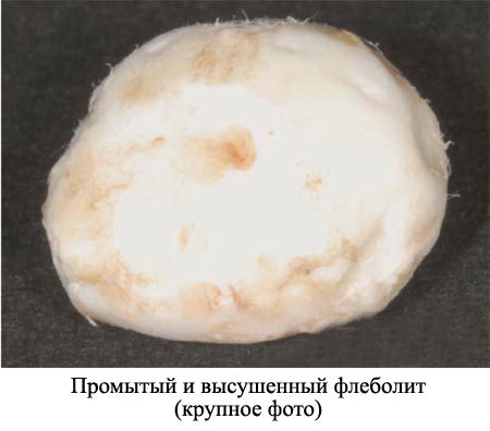 Флеболиты в малом тазу у мужчин - Все про холестерин