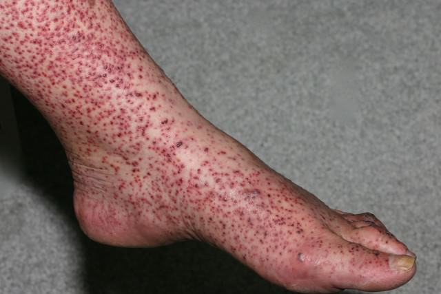 Васкулит на ногах - что это такое и как лечить?