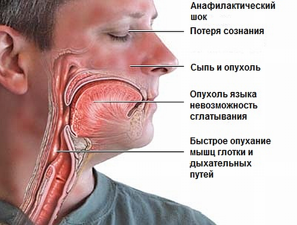 Аллергия на алкоголь (пиво, вино, водка): симптомы, фото, лечение