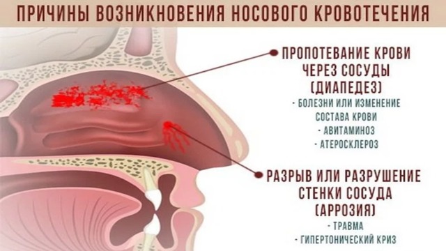 Что делать, если идет кровь из носа
