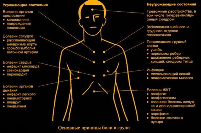 Боль в грудине: причины болевых ощущений слева, справа и посередине грудной клетки (видео)