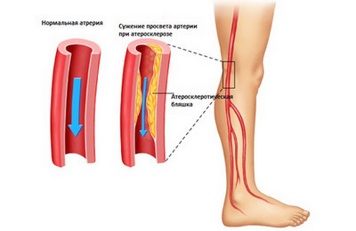Что такое эндартериит - симптомы и лечение