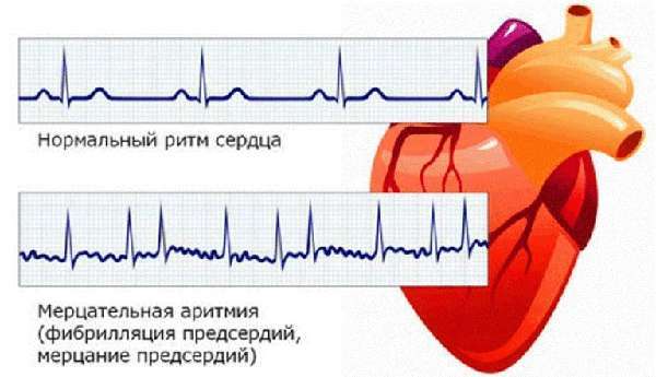 Сильное сердцебиение: причины, что делать