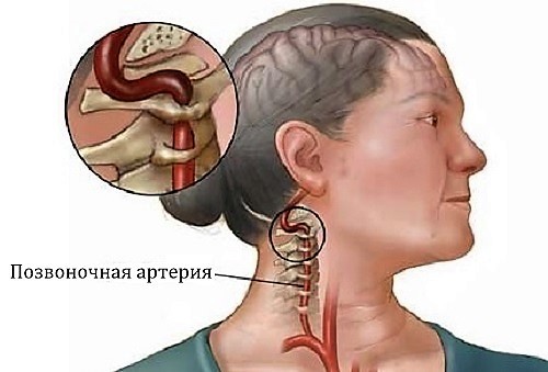 Синдром позвоночной артерии – причины, симптомы, лечение, упражнения при синдроме позвоночной артерии