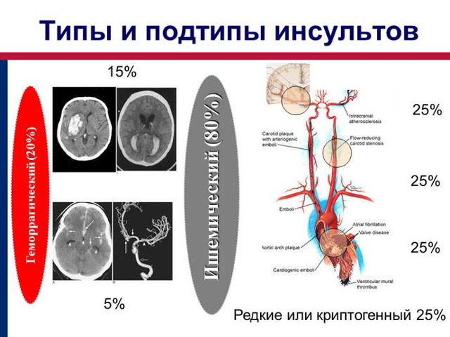 Таблетки от инсульта