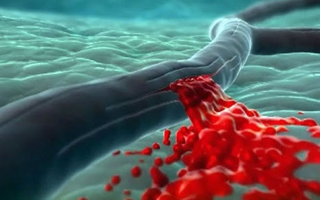 Сопор и кома при инсульте - Инсульт . Реабилитация