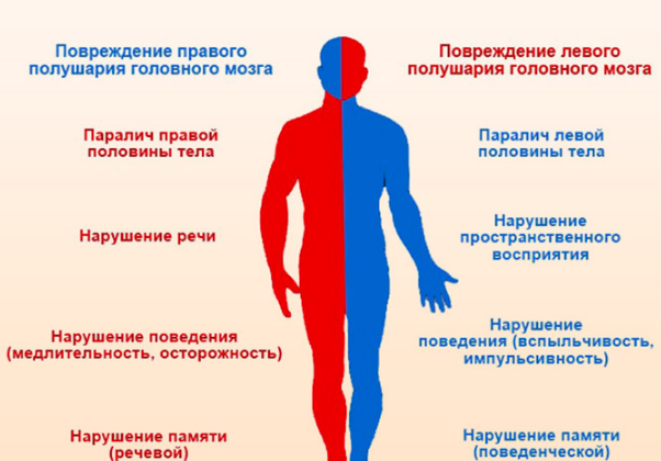 Инсульт левая или правая сторона, последствия, сколько живут