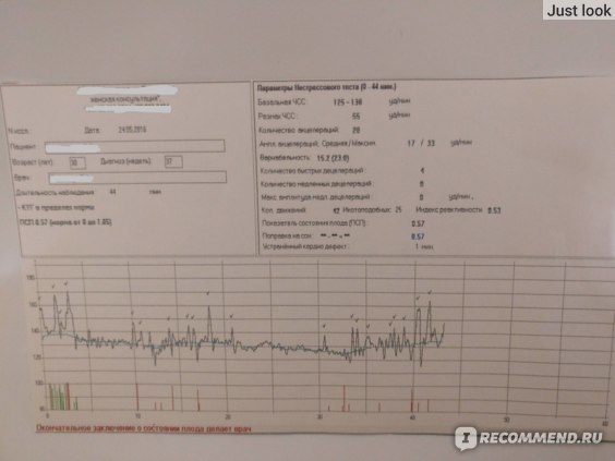 КТГ при беременности: что это такое и зачем оно проводится? Расшифровка результатов КТГ