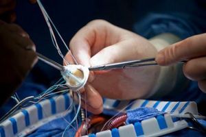 Уплотнение аорты – причины, симптомы, осложнения и лечение уплотнения аорты