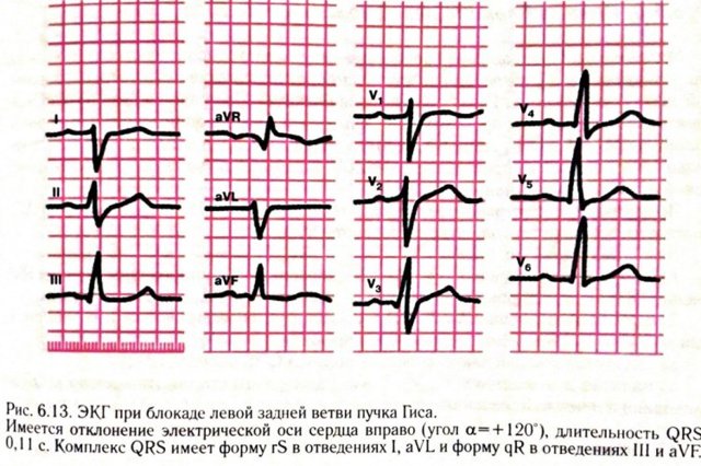 ЭКГ при блокаде правой ножки пучка Гиса (ПНПГ)