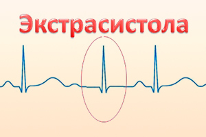 Экстрасистолы после рча - Все про гипертонию