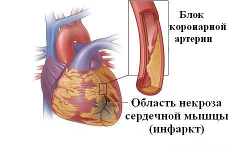 Анализ крови на липидный обмен