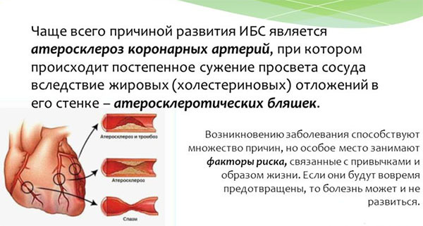Классификация ИБС по международной классификации заболеваний: диагностика и систематизация, особенности, виды и подвиды заболеваний, факторы риска