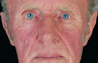 Что такое Полицитемия?