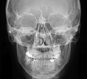 Клиническая анатомия носа. Кровоснабжение полости носа