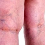 На лице видны вены что делать » Полезный блог обо всем