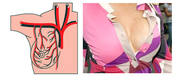 Выступают вены на руках у женщин и мужчин: причины, лечение сильно выпирающих вен
