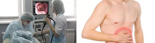 Катаральный гастрит - симптомы и лечение заболевания