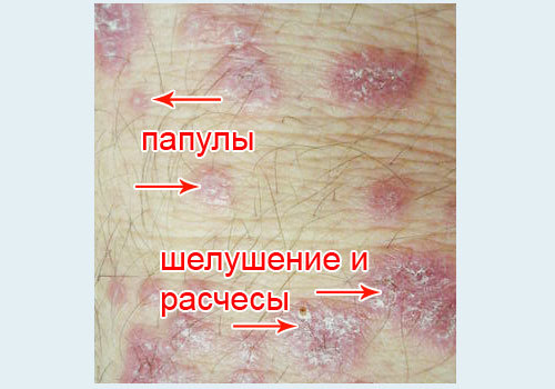 Красный плоский лишай у человека: фото, признаки и лечение