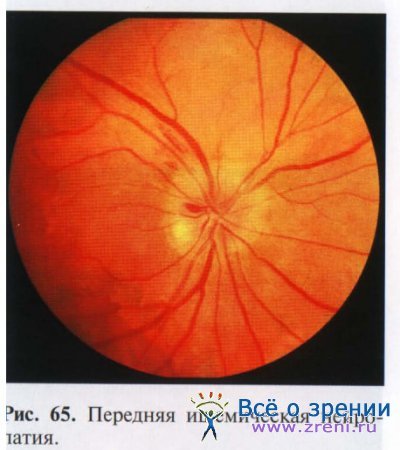 Ишемические заболевания сетчатки глаза и зрительного нерва